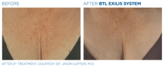 Before and After Neck-Chest Exilis Treatment | B Medical Spa and Wellness Center | bmedspa | San Diego, CA