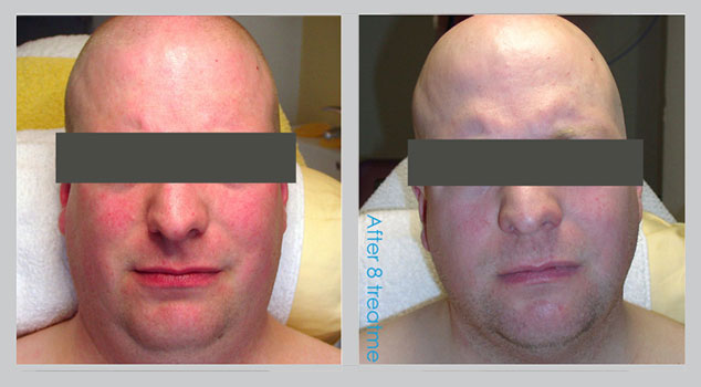 Before and After Male Face i-LIPO Treatment Result | B Medical Spa and Wellness Center | bmedspa | San Diego, CA