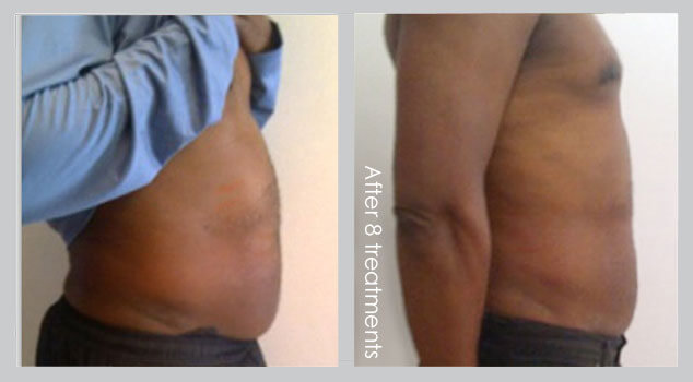 Before and After Male i-LIPO Laser Fat Reduction Treatment Result | B Medical Spa and Wellness Center | bmedspa | San Diego, CA