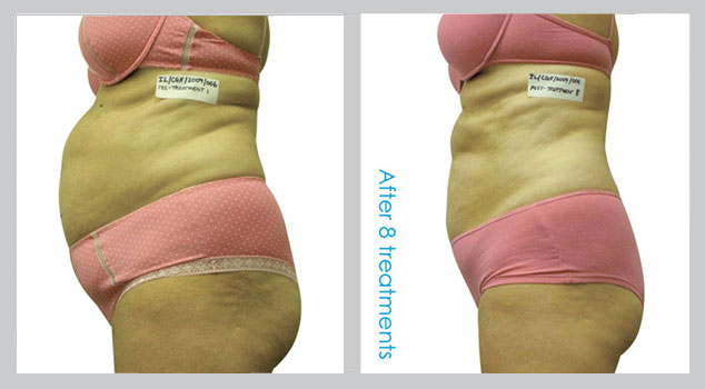 Before and After i-LIPO Laser Fat Reduction Treatment | B Medical Spa and Wellness Center | bmedspa | San Diego, CA