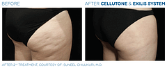 Before and After Buttocks Exilis Treatment | B Medical Spa and Wellness Center | bmedspa | San Diego, CA