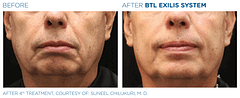 Before and After Male Face Exilis Treatment | B Medical Spa and Wellness Center | bmedspa | San Diego, CA