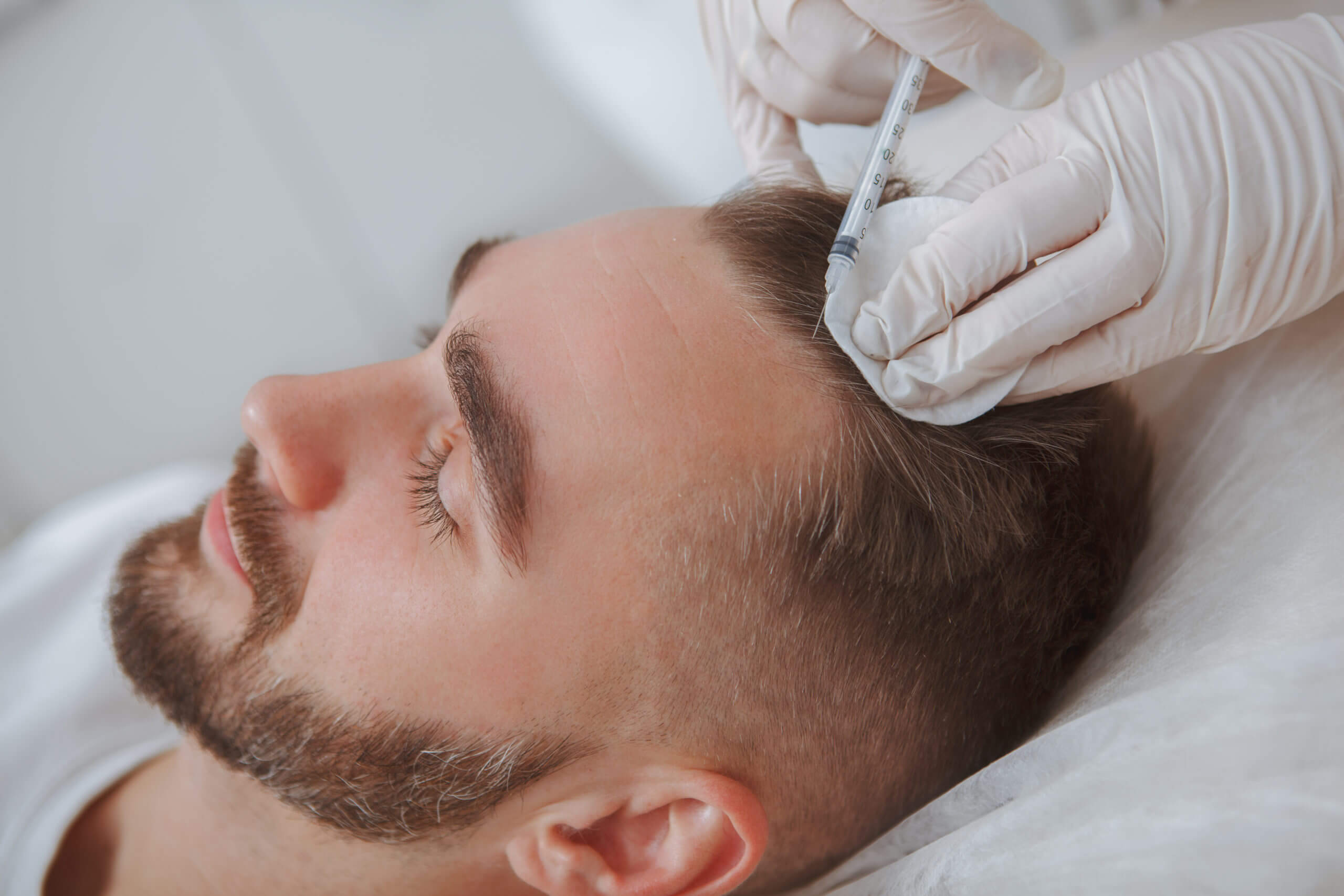 What Is PRP For Hair Loss? How It Works For Hair Regrowth | B Medical Spa and Wellness Center | bmedspa | San Diego, CA