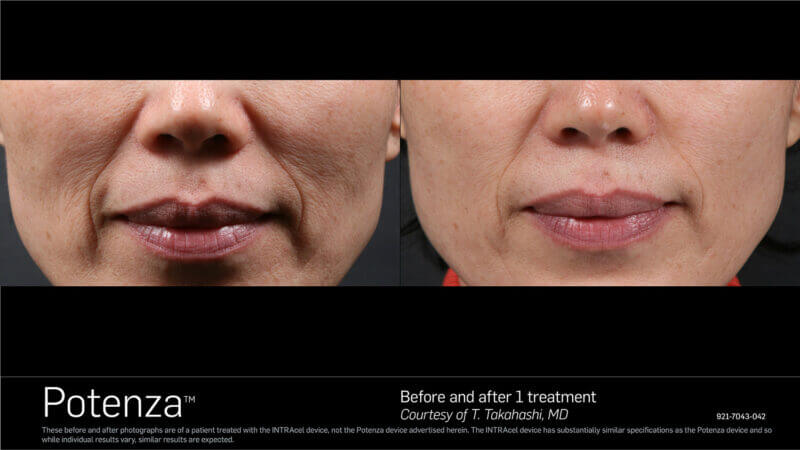 Before and After Potenza RF Microneedling Treatment | B Medical Spa and Wellness Center | bmedspa | San Diego, CA