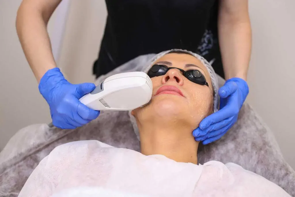 IPL Photo Facial Treatment by B Medical Spa In San Diego, CA
