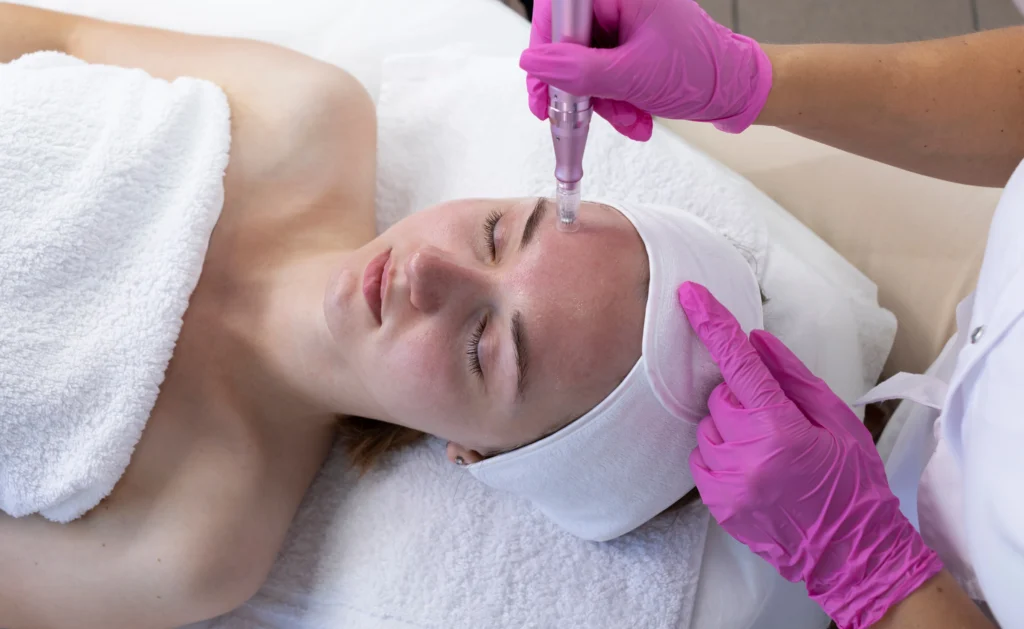 Skinpen Microneedling | San Diego CA | B Med Spa