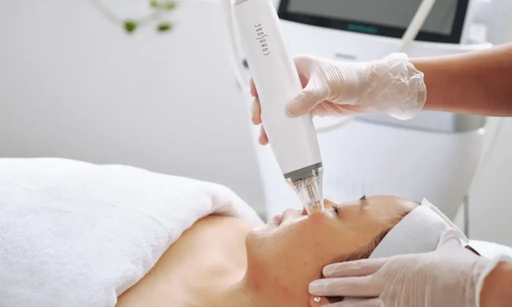 Potenza RF Microneedling Acne Scar