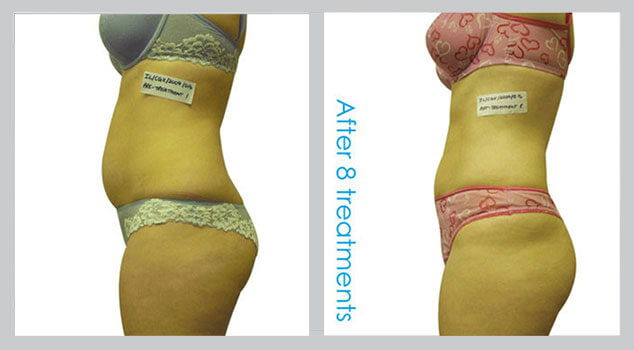 Before and After Result i-LIPO Laser Fat Reduction Treatment | B Medical Spa and Wellness Center | bmedspa | San Diego, CA