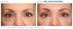 Before and After Female Face Exilis Treatment | B Medical Spa and Wellness Center | bmedspa | San Diego, CA