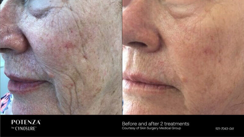 Before and After Treatment of Potenza RF Microneedling | B Medical Spa and Wellness Center | bmedspa | San Diego, CA