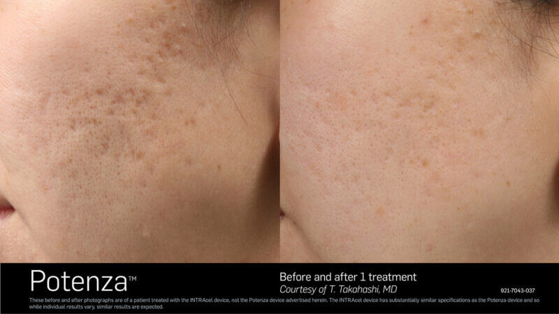 Before and After Result of Potenza RF Microneedling Treatment | B Medical Spa and Wellness Center | bmedspa | San Diego, CA