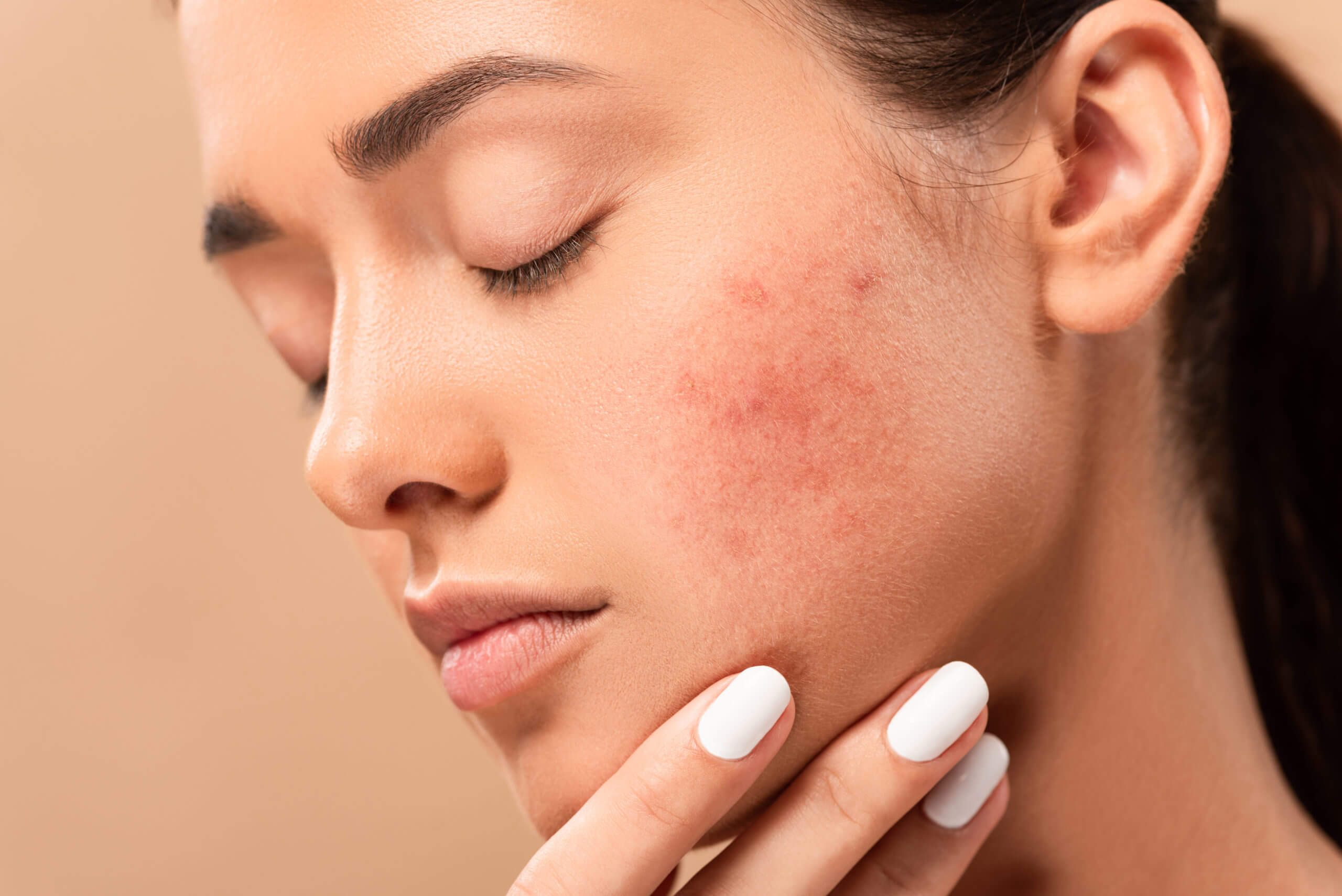 What Are The Best Treatments For Acne Scars