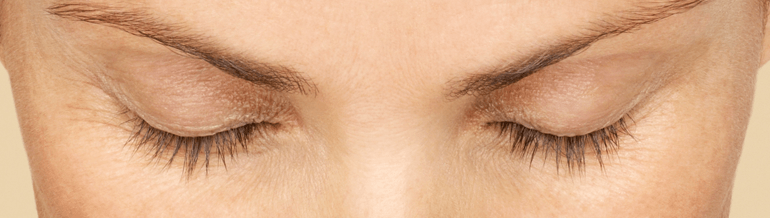 Latisse Before | San Diego, CA | B Medical Spa